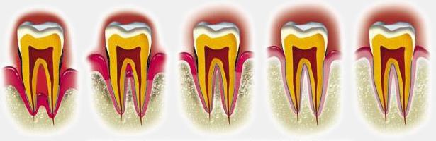 periodontitis nasıl tedavi edilir